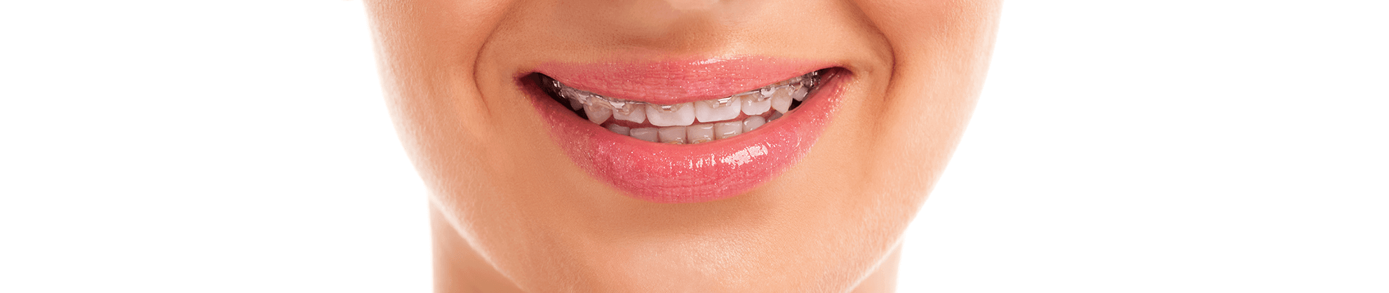Orthodontic Services - Spanish