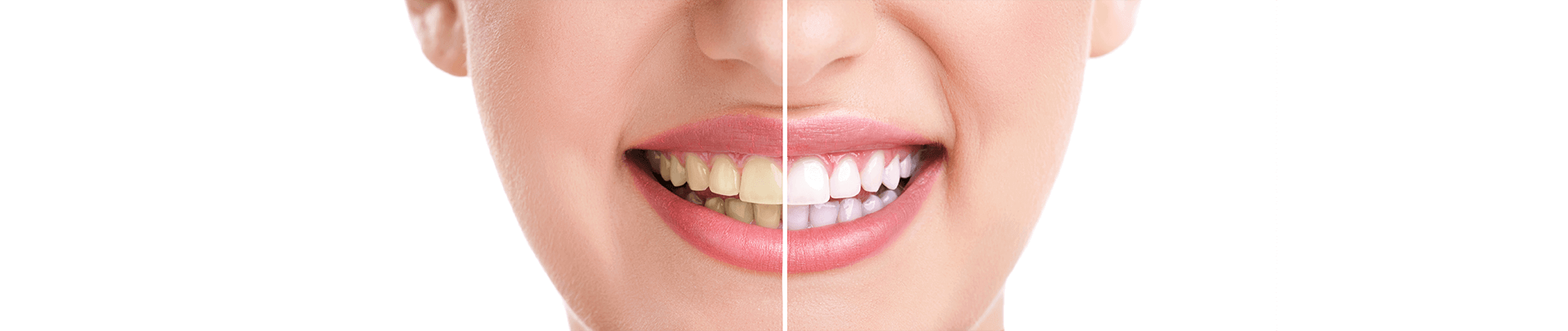 Teeth Whitening in Waukegan, Illinois
